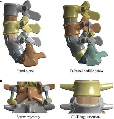 Poor bone mineral density aggravates adjacent segment's motility compensation in patients with oblique lumbar interbody fusion with and without pedicle screw fixation: An in silico study